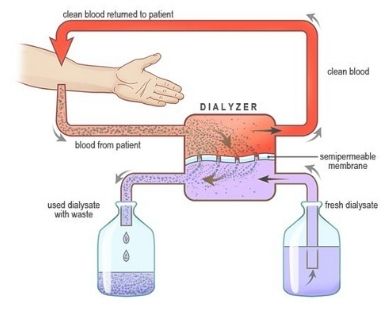 Dialysis in delhi